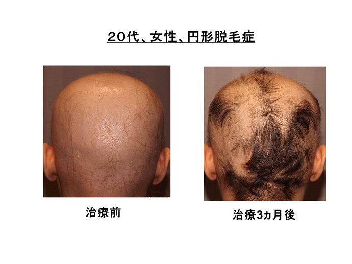 円形脱毛症　病院""
